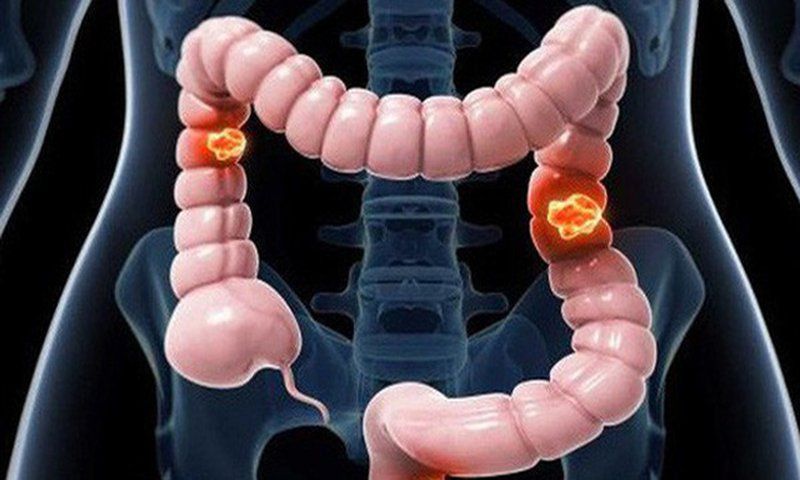 Nội soi đại tràng ống mềm không sinh thiết