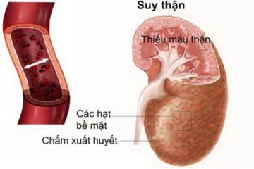 Viêm ống kẽ thận cấp: Nguyên nhân, triệu chứng, biến chứng