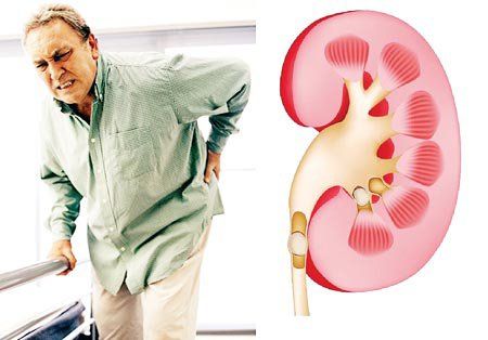 Viêm ống kẽ thận cấp: Nguyên nhân, triệu chứng, biến chứng