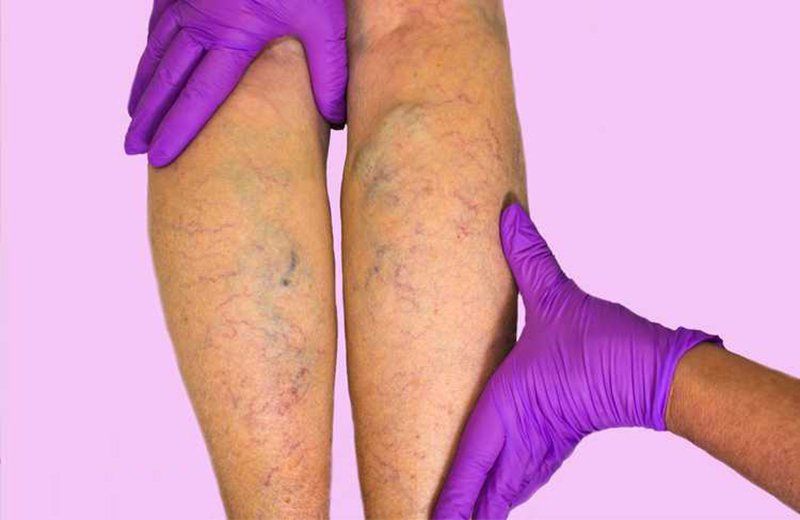 Phù chân khi đứng lâu, có phải mắc bệnh mạch máu?