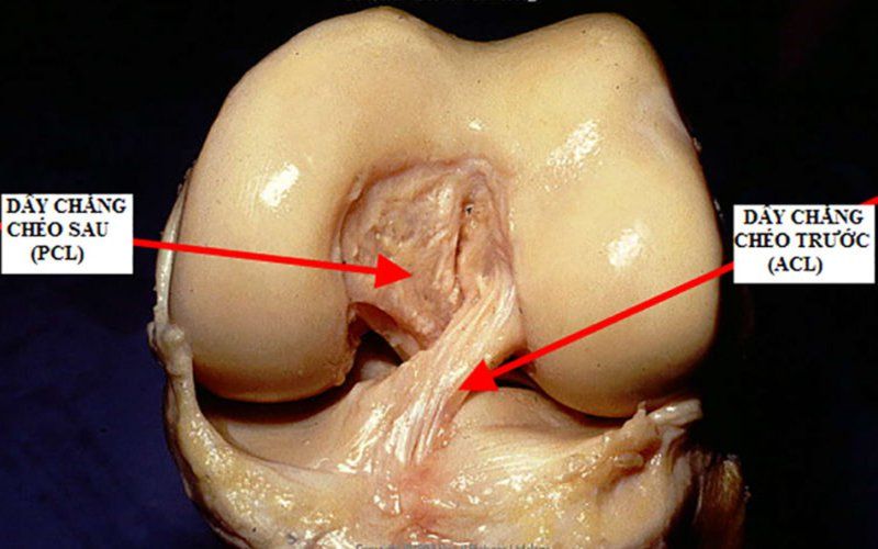 Sử dụng gân tự thân trong tạo hình dây chằng chéo khớp gối