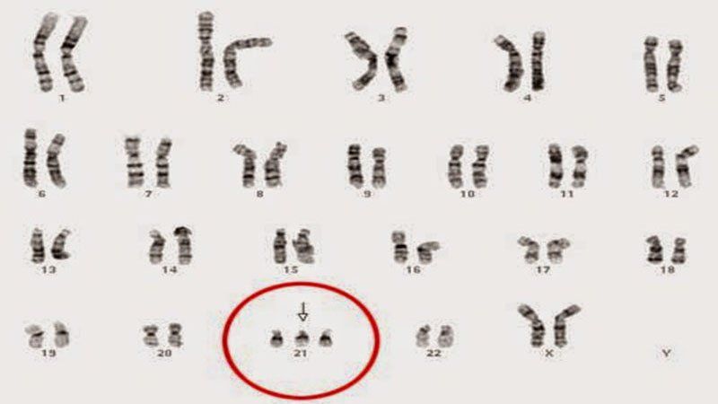 Thận móng ngựa: Nguyên nhân, triệu chứng và cách điều trị