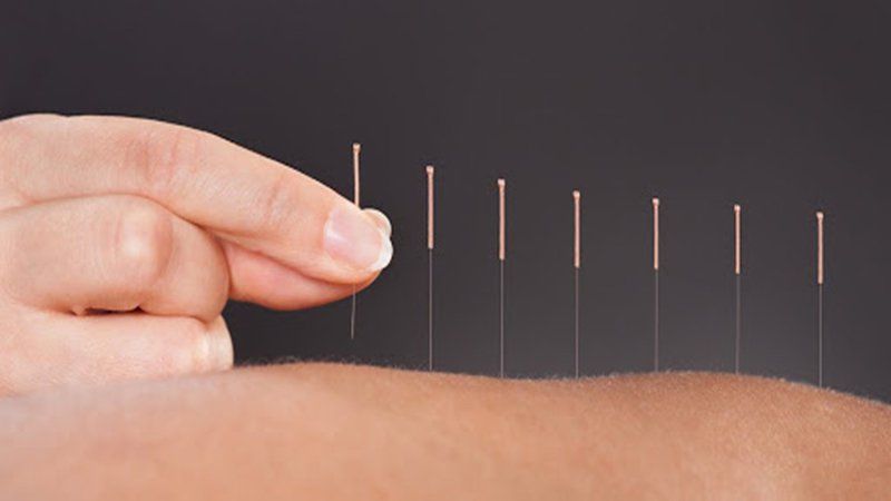 Điện châm điều trị hội chứng vai gáy