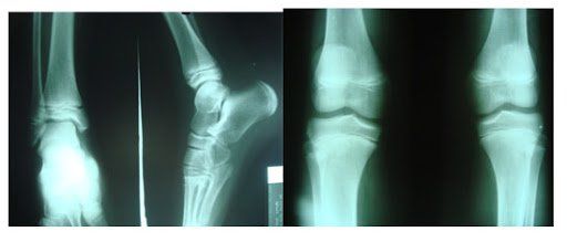 Khi nào thực hiện chụp X quang khớp thường quy?