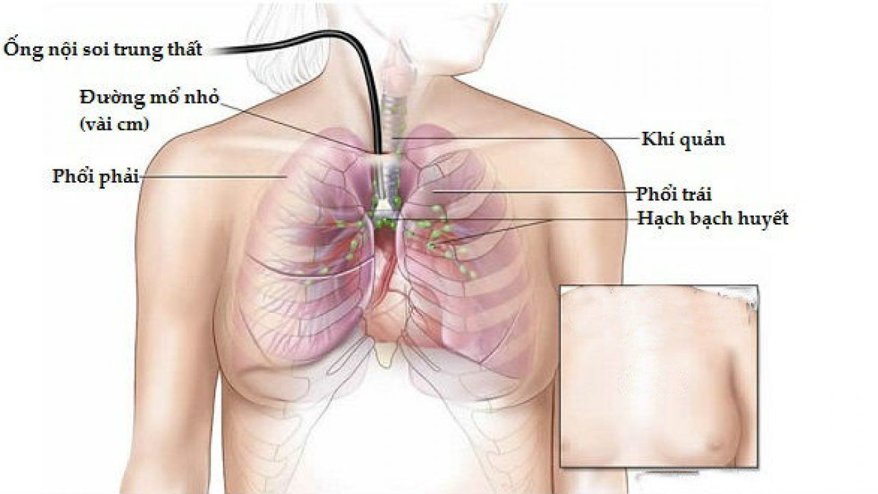 Phẫu thuật nội soi lồng ngực sinh thiết khối u hạch trung thất