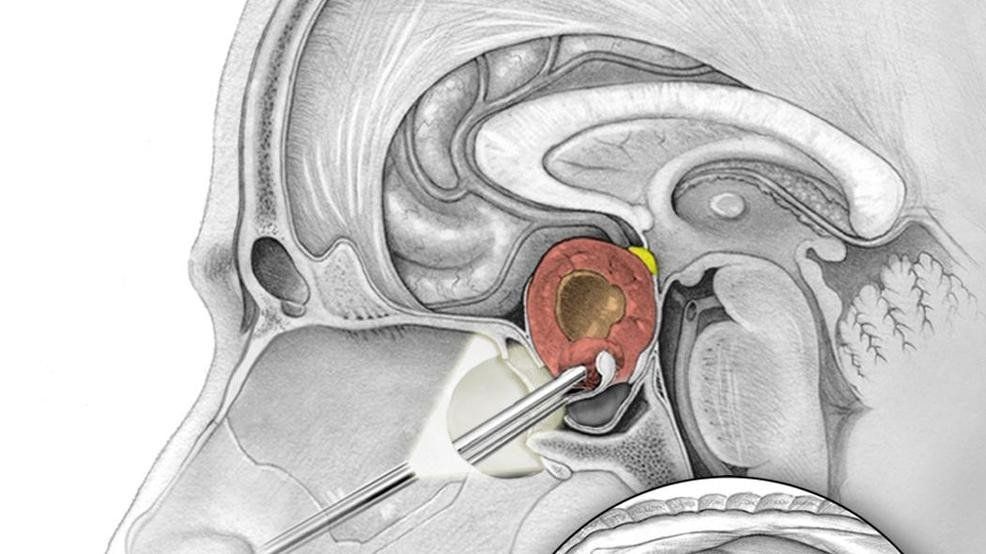 Quy trình phẫu thuật nội soi cắt bỏ u tuyến yên qua đường xương bướm