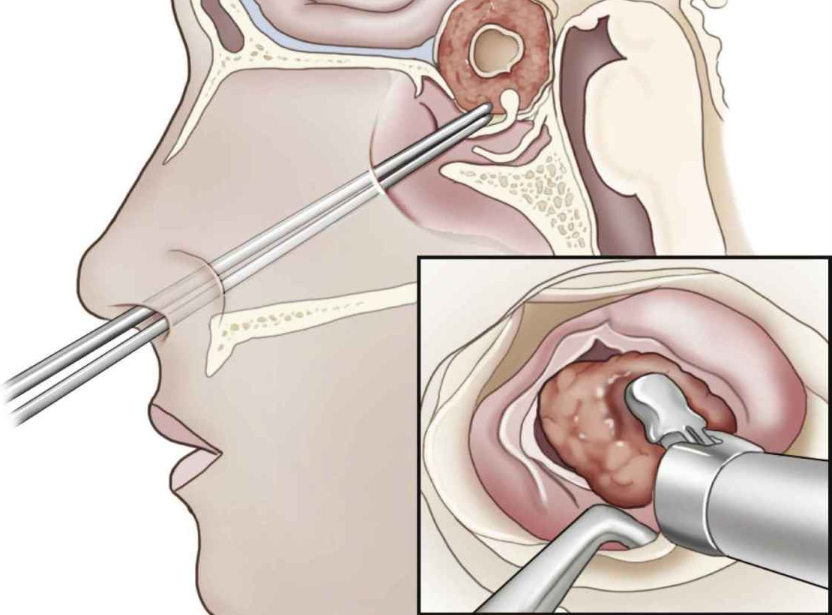 Rủi Ro và Biến Chứng Của Phẫu Thuật U Tuyến Yên