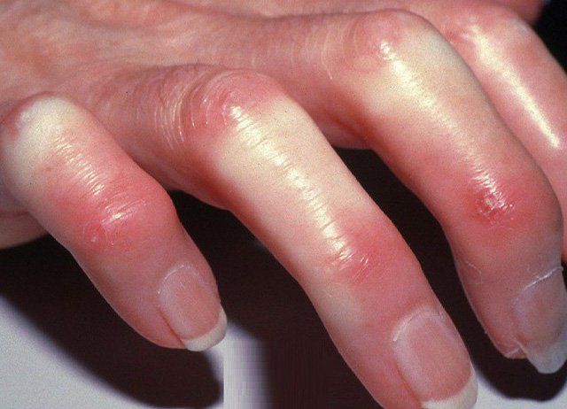 Triệu chứng lâm sàng của bệnh Parkinson