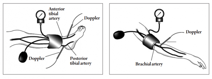 Tìm hiểu chỉ số huyết áp cổ chân - cánh tay ( ABI)
