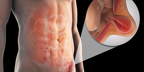 Những thay thế của giảm đau ngoài màng cứng