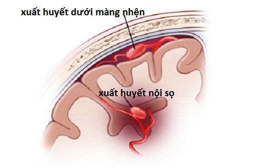Chảy máu dưới nhện Phần 2: Biểu hiện lâm sàng và chẩn đoán