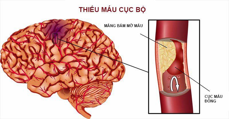 Chảy máu dưới nhện Phần 3: Đánh giá ban đầu