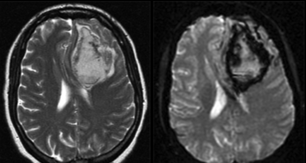 Hướng dẫn cách đọc kết quả MRI sọ não