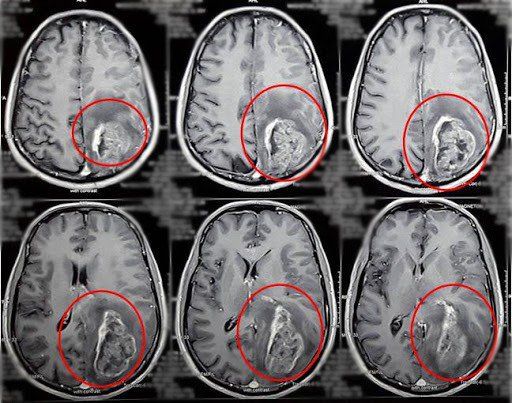 Quy trình chụp cộng hưởng từ sọ não không tiêm thuốc đối quang từ