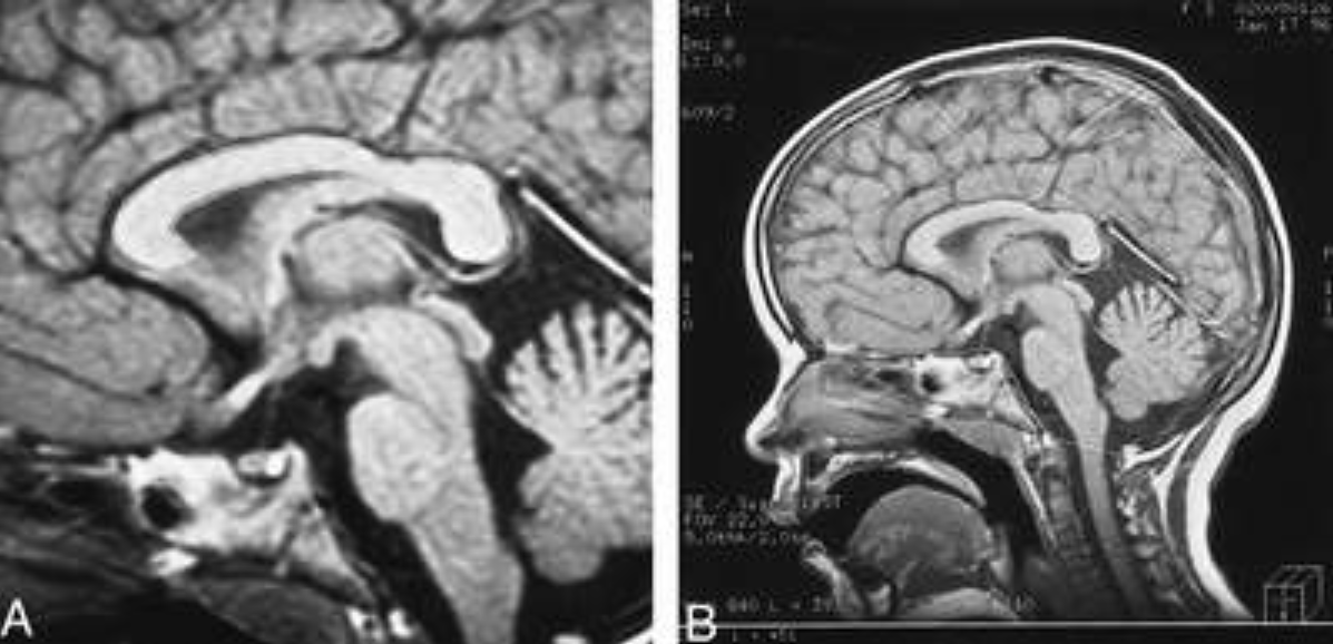 Hướng dẫn cách đọc kết quả MRI sọ não