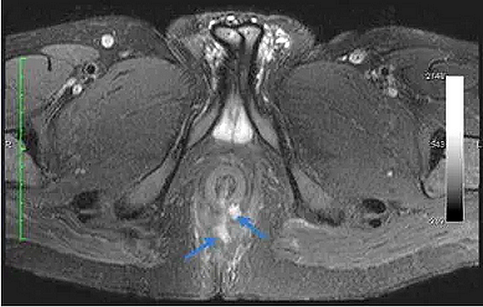 Tìm hiểu về chụp Cộng hưởng từ rò hậu môn