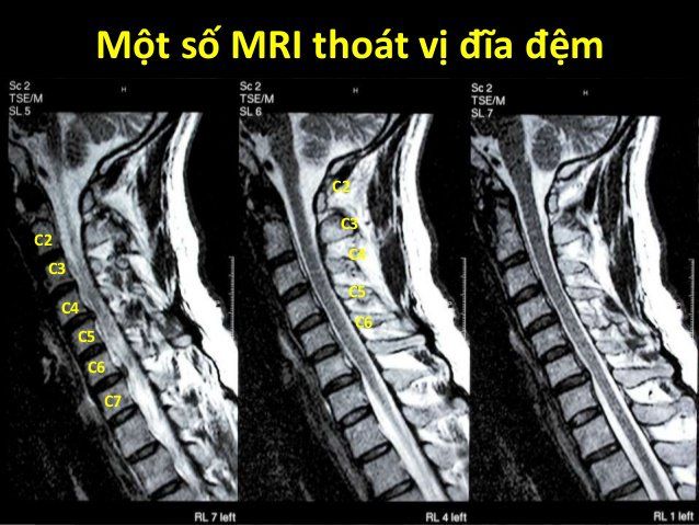 Trường hợp nào chỉ định chụp MRI cột sống thắt lưng?-P2