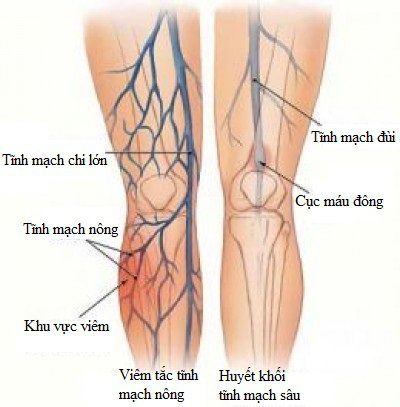 Tắc động mạch nuôi chi cấp tính có nguy hiểm?