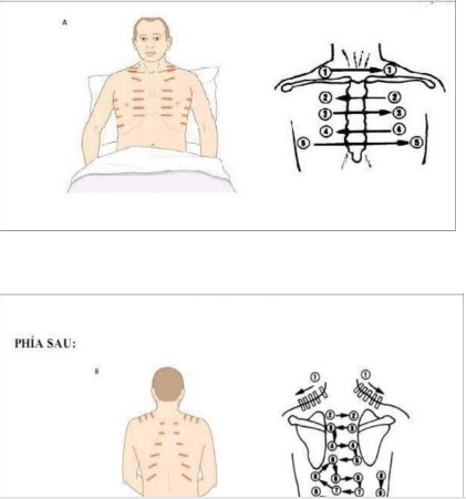 Kỹ thuật chọc hút khí màng phổi cấp cứu