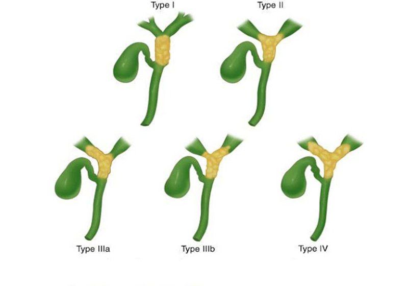 Mổ nội soi cắt nang ống mật chủ