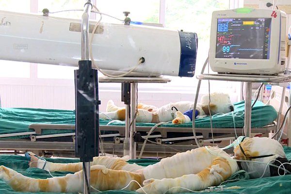 Phân độ và biến chứng sốc bỏng