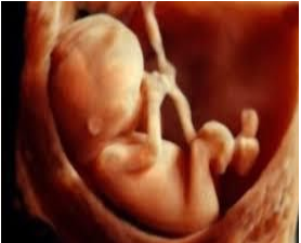 ARSA được xác định trên siêu âm thai như thế nào?