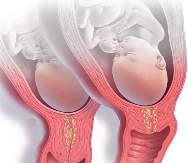Thuốc chống sinh non Atosiban được sử dụng khi nào? Những điều cần lưu ý