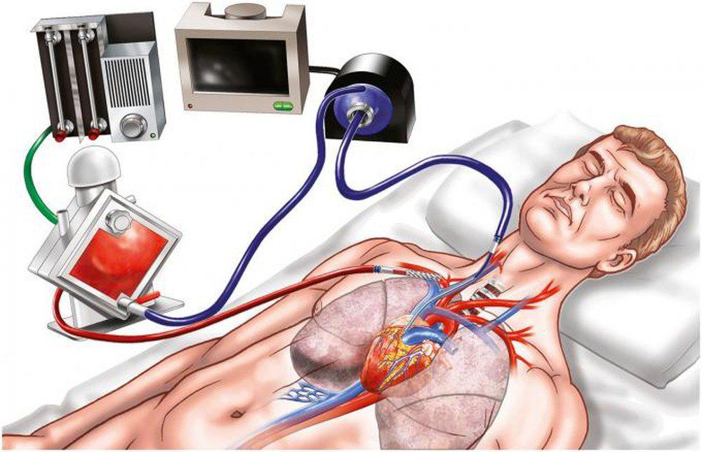 Tìm hiểu về kỹ thuật ECMO (Tim - phổi nhân tạo)