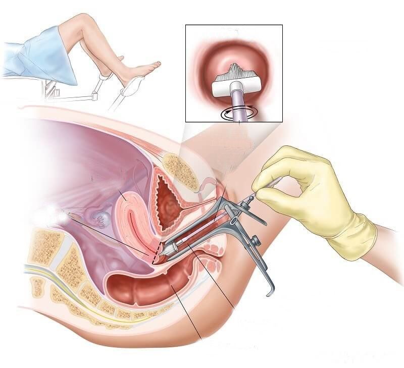 Xét nghiệm Pap sau mãn kinh