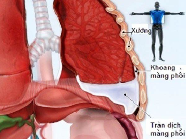 Rút ống dẫn lưu màng phổi, dẫn lưu ổ áp xe phổi
