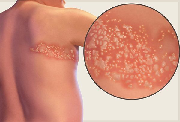 Các tình huống đặc biệt khi tiêm vắc-xin ngừa virus herpes (Zoster vaccination)