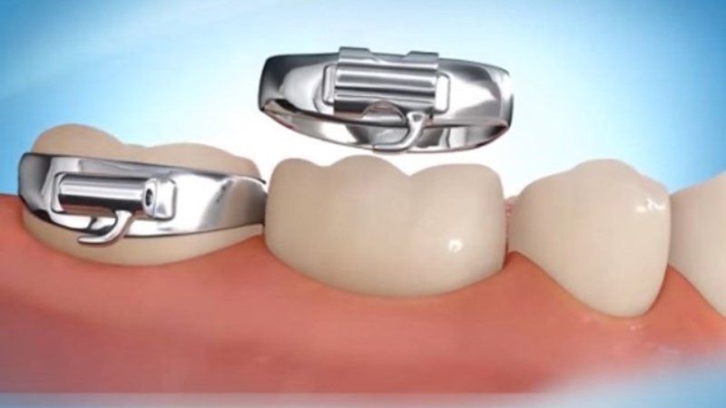 Đặt thun tách kẽ răng để làm gì?