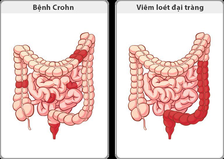 Hình ảnh trực quan mô phỏng bệnh tự miễn