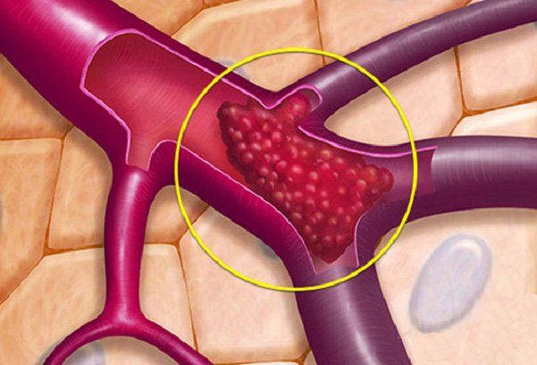 Chụp số hóa xóa nền và nút giãn tĩnh mạch buồng trứng