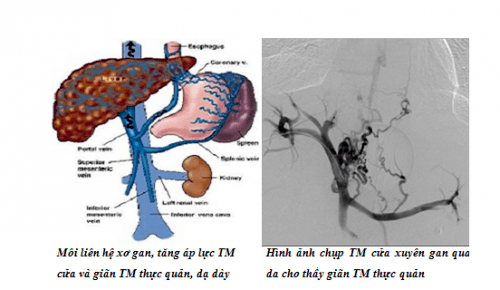 Chụp số hóa xóa nền và gây tắc búi giãn tĩnh mạch thực quản qua da