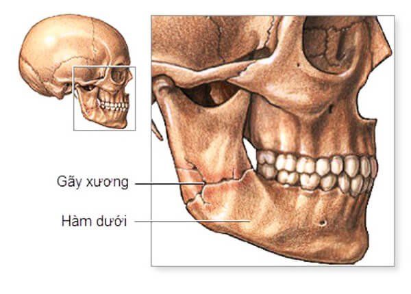 Kiểm soát đường thở ở nạn nhân có dấu hiệu chấn thương hàm mặt