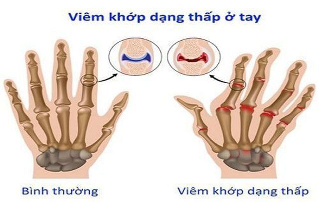 Xét nghiệm yếu tố dạng thấp (RF) trong viêm khớp dạng thấp