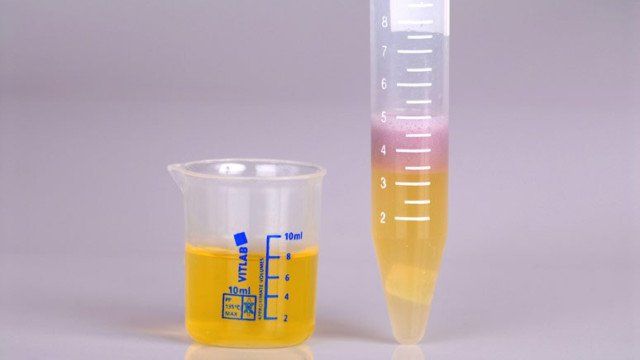 Nitrit là gì? Khi nào nên xét nghiệm nitrit trong nước tiểu