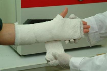 Nẹp bột và máng bột trong điều trị chấn thương gãy xương