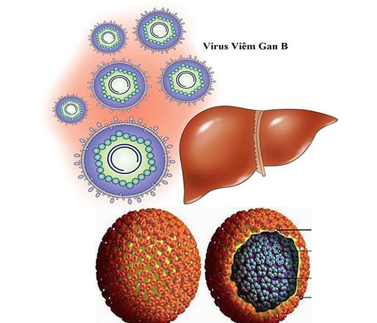 Virus viêm gan D: Nguyên nhân, triệu chứng, chẩn đoán