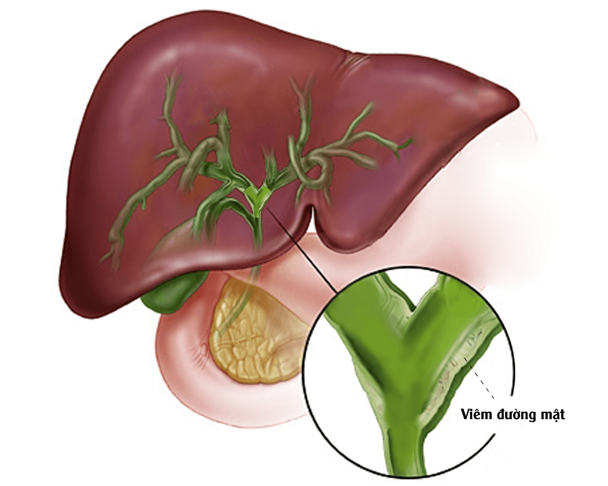 Chảy máu đường mật: Nguyên nhân, triệu chứng và cách điều trị