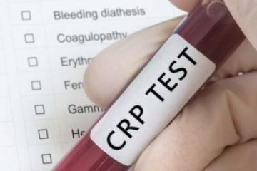 Các xét nghiệm trong Lab dùng để chẩn đoán Lupus