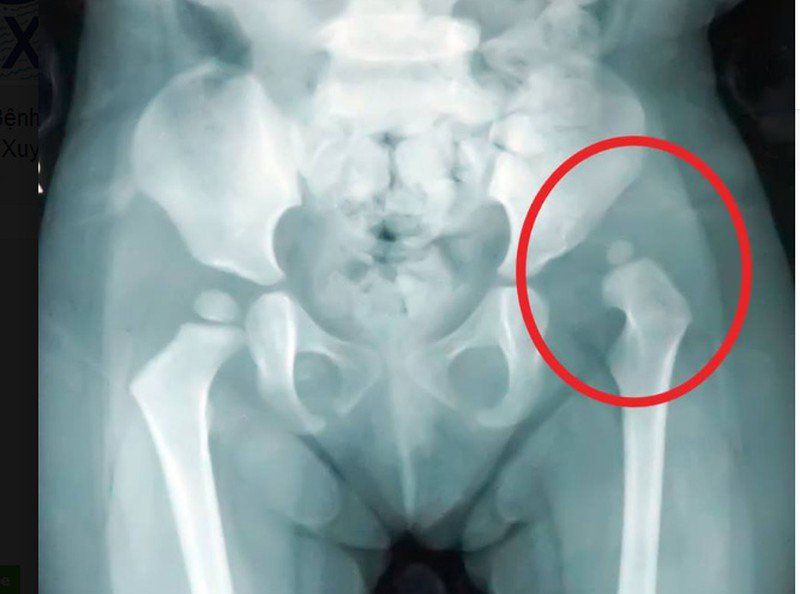 Siêu âm khớp háng: Những điều cần biết