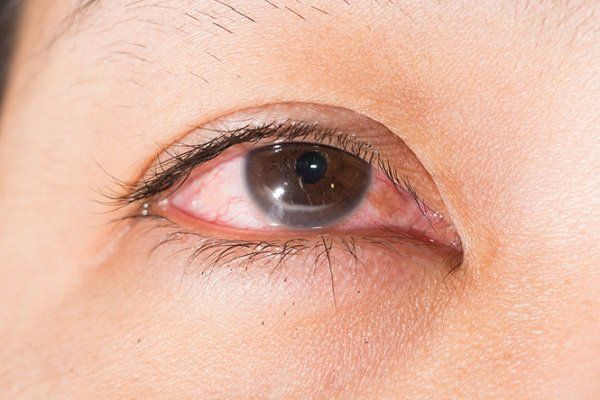 Kết mạc là gì? Chức năng của kết mạc