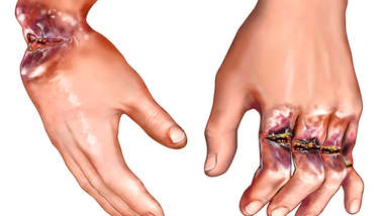 Hội chứng vùi lấp: Những điều cần biết