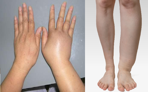 Hội chứng vùi lấp: Những điều cần biết