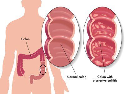 Phòng ngừa biến chứng bệnh Crohn