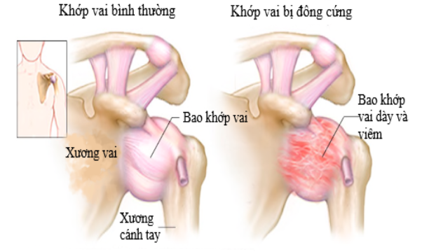 Tiêm phá đông khớp vai dưới X quang tăng sáng