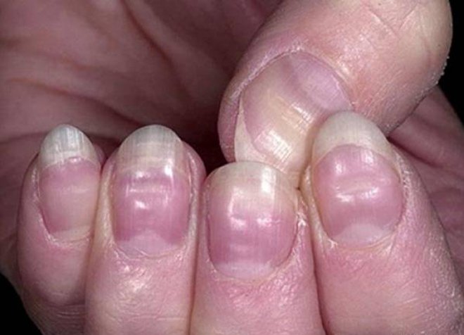 Móng tay lõm hình thìa: Nguyên nhân và cơ chế sinh bệnh