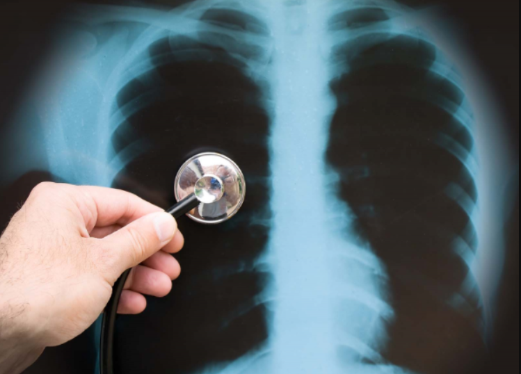 X-quang ngực có chẩn đoán bệnh phổi tắc nghẽn mạn tính (COPD) không?